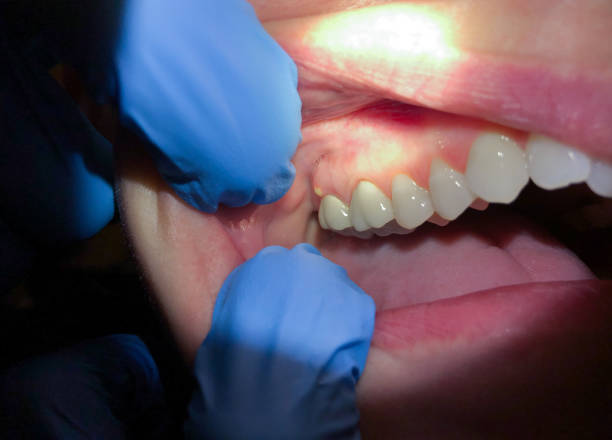 Best Emergency Wisdom Teeth Removal in Tracy City, TN